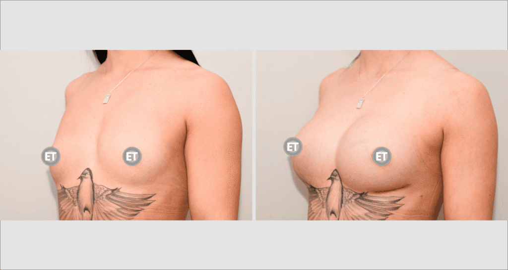 Vorher/Nachher Ergebnis: Brustvergroesserung Mit Implantaten