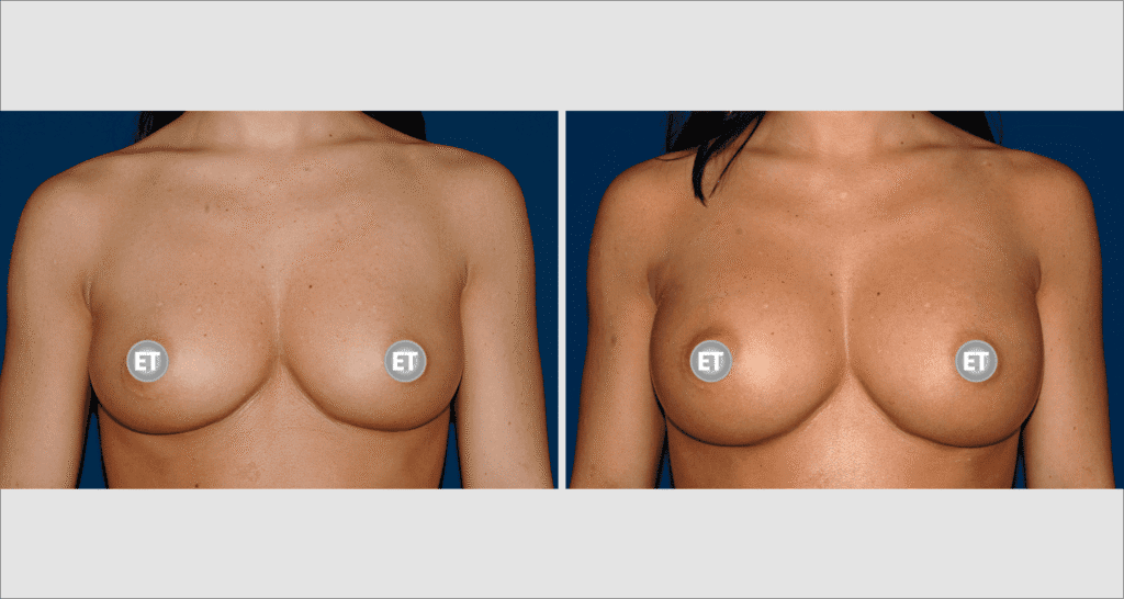 Vorher/Nachher Ergebnis: Brustvergroesserung Mit Implantaten
