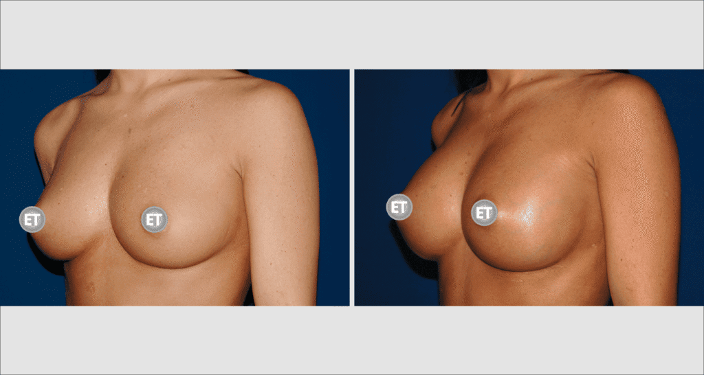 Vorher/Nachher Ergebnis: Brustvergroesserung Mit Implantaten