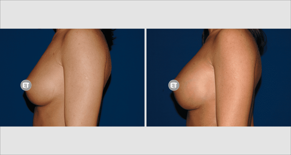 Vorher/Nachher Ergebnis: Brustvergroesserung Mit Implantaten