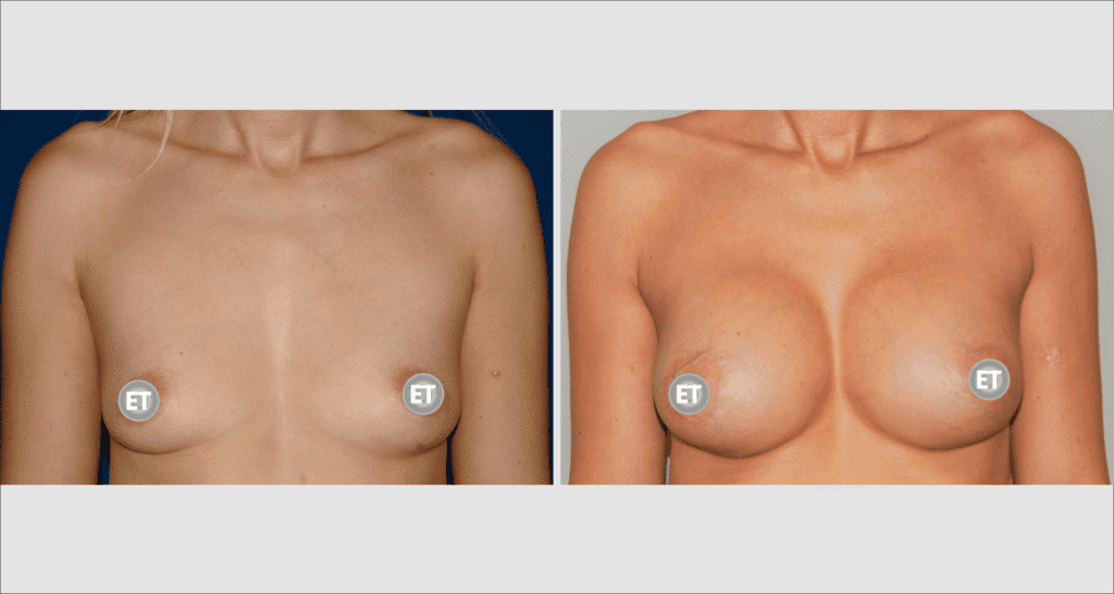 Vorher/Nachher Ergebnis: Brustvergroesserung Mit Implantaten