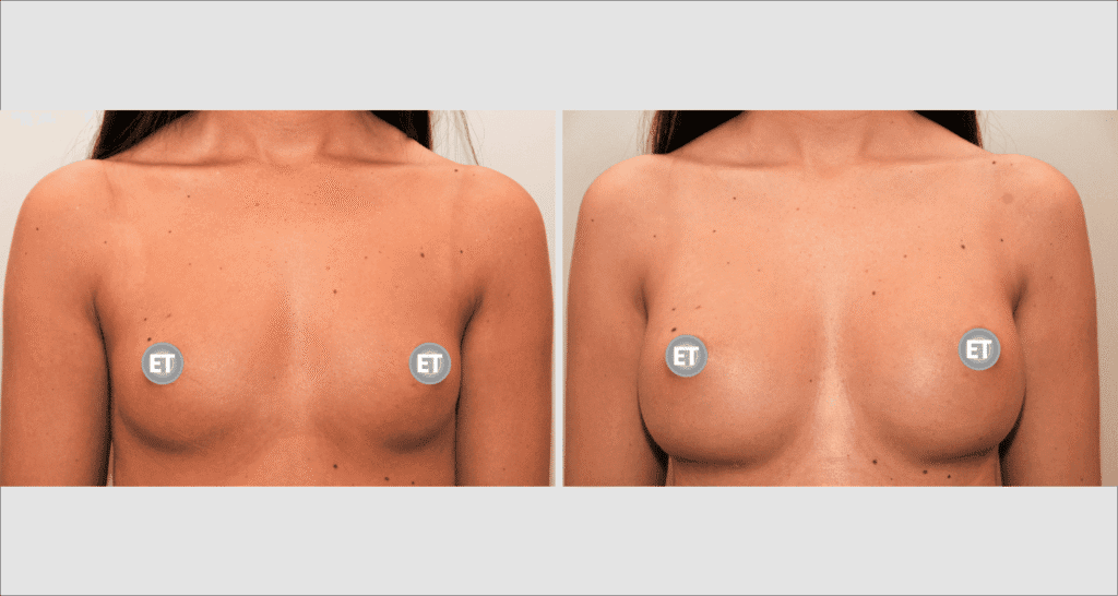 Vorher/Nachher Ergebnis: Brustvergroesserung Mit Implantaten