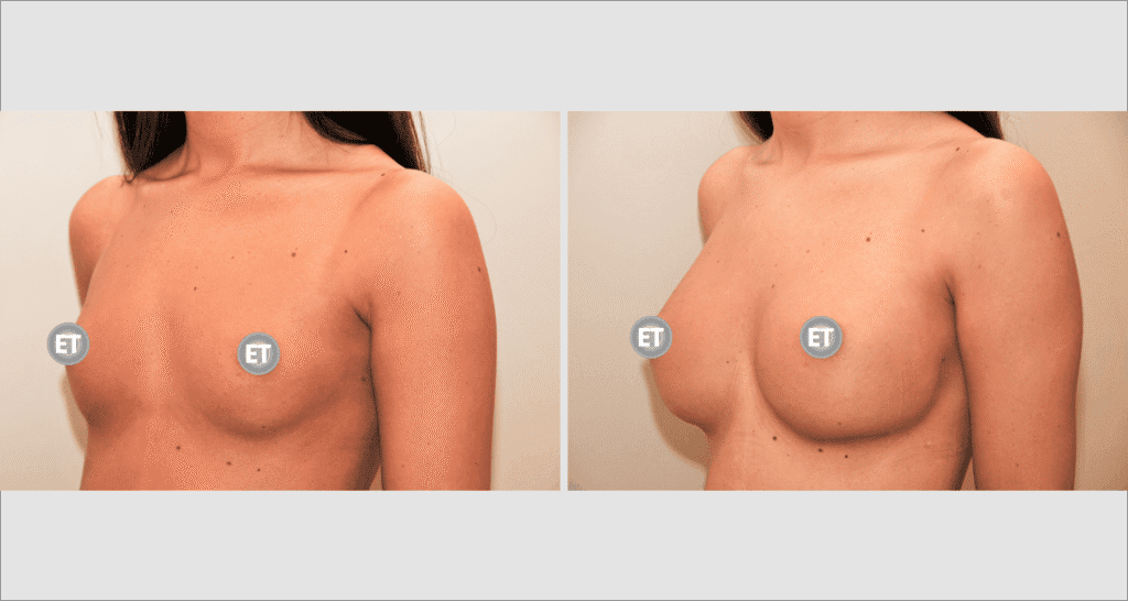 Vorher/Nachher Ergebnis: Brustvergroesserung Mit Implantaten