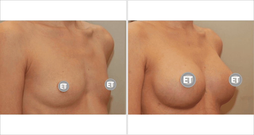 Vorher/Nachher Ergebnis: Brustvergroesserung Mit Implantaten