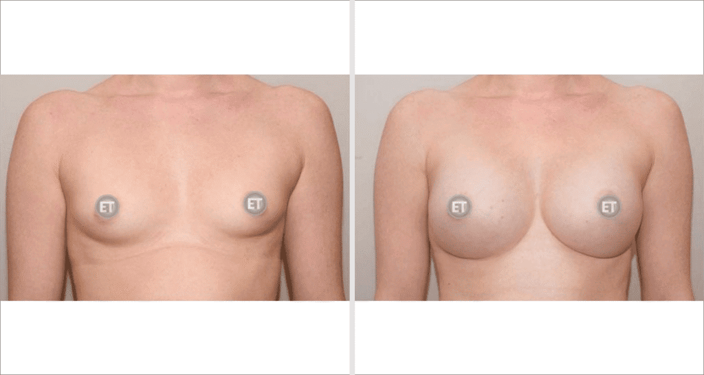Vorher/Nachher Ergebnis: Brustvergroesserung Mit Implantaten