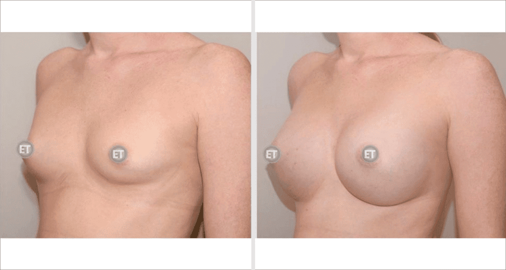 Vorher/Nachher Ergebnis: Brustvergroesserung Mit Implantaten