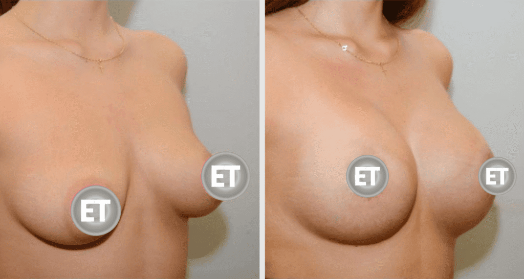 Vorher/Nachher Ergebnis: Brustvergroesserung Mit Implantaten