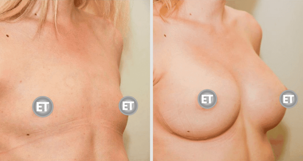 Vorher/Nachher Ergebnis: Brustvergroesserung Mit Implantaten