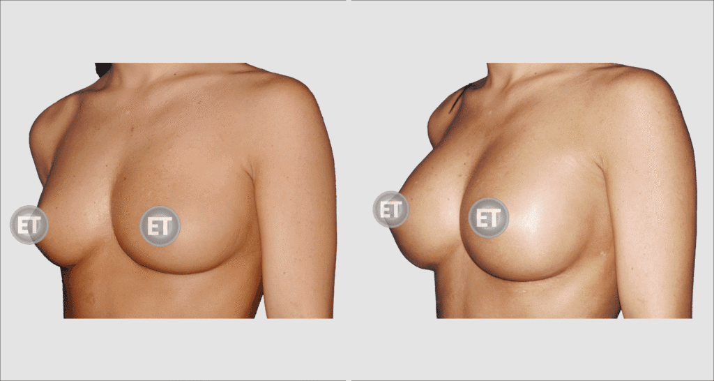 Vorher/Nachher Ergebnis: Brustvergroesserung Mit Implantaten