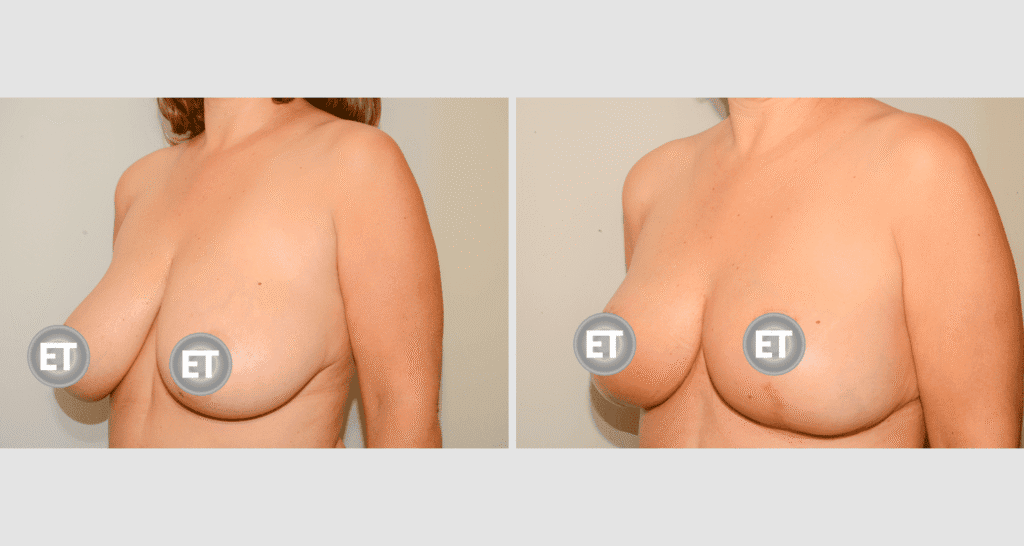 Vorher/Nachher Ergebnis: Brustverkleinerung