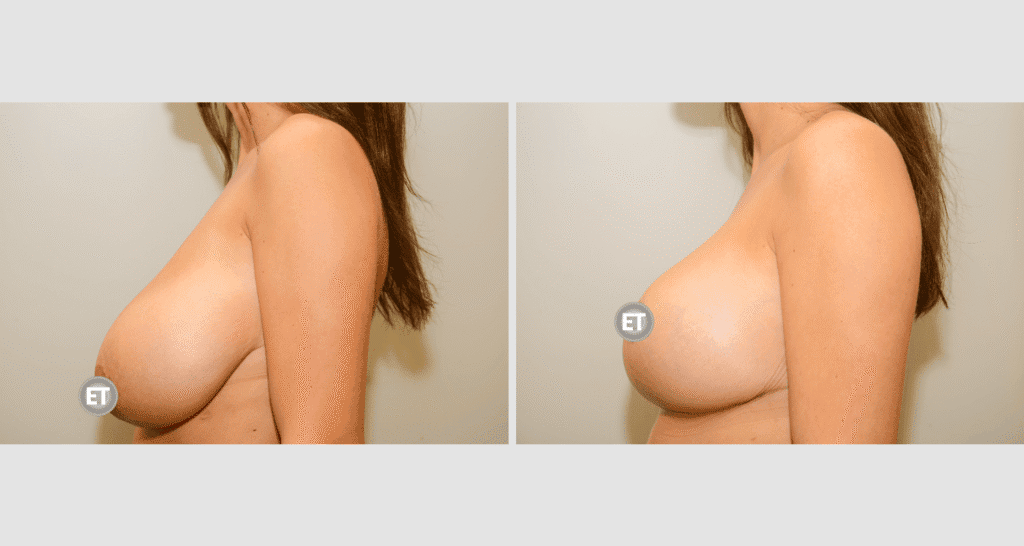 Vorher/Nachher Ergebnis: Brustverkleinerung