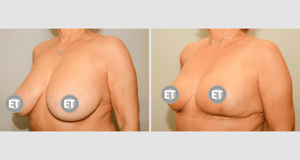 Vorher/Nachher Ergebnis: Brustverkleinerung