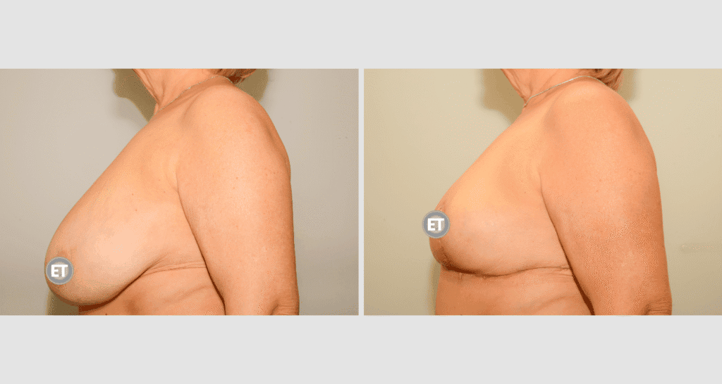 Vorher/Nachher Ergebnis: Brustverkleinerung