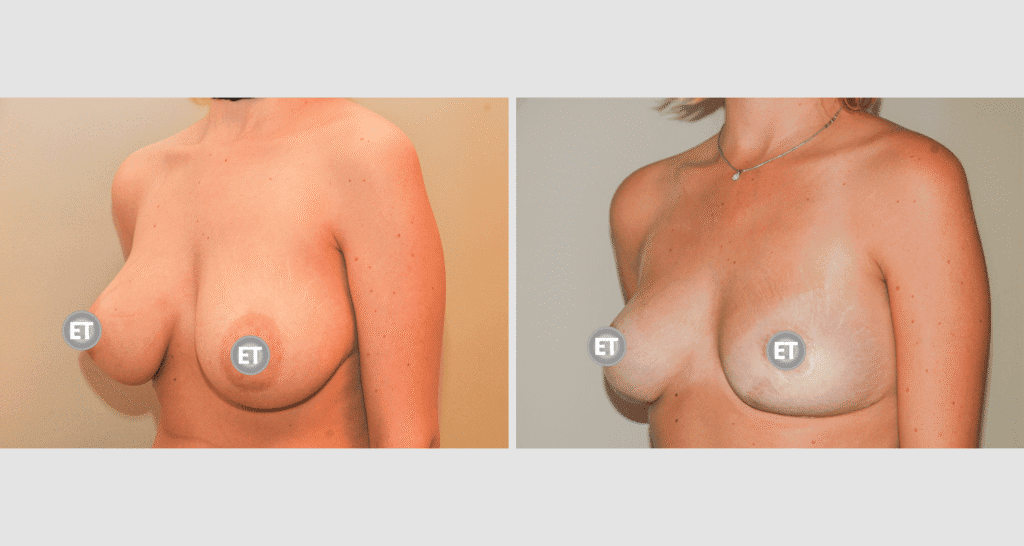 Vorher/Nachher Ergebnis: Brustverkleinerung