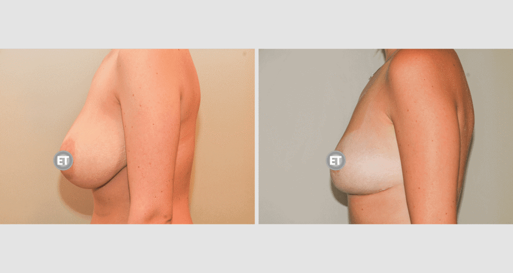 Vorher/Nachher Ergebnis: Brustverkleinerung