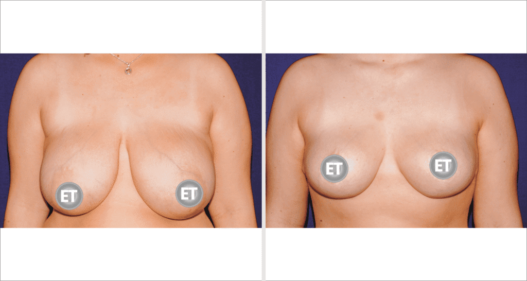 Vorher/Nachher Ergebnis: Brustverkleinerung