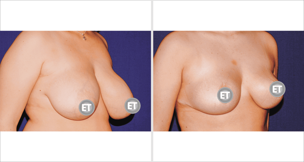 Vorher/Nachher Ergebnis: Brustverkleinerung