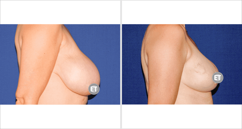 Vorher/Nachher Ergebnis: Brustverkleinerung