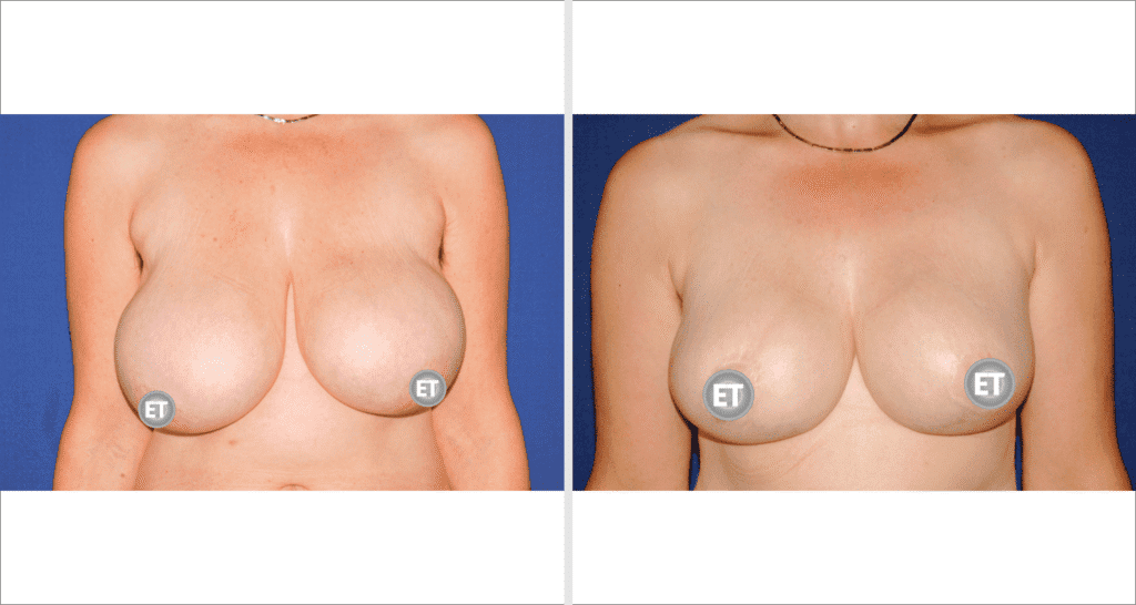 Vorher/Nachher Ergebnis: Brustverkleinerung