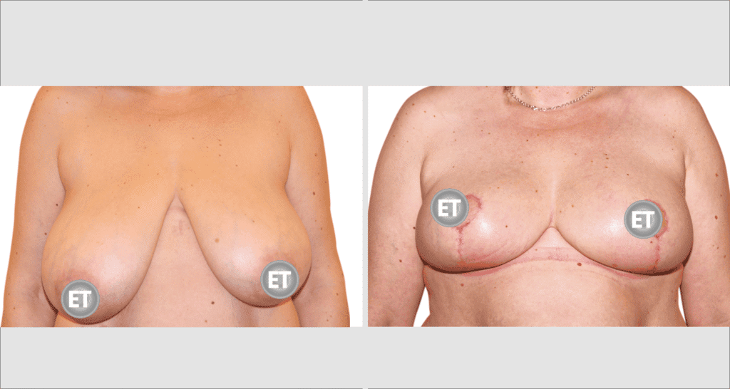 Vorher/Nachher Ergebnis: Brustverkleinerung