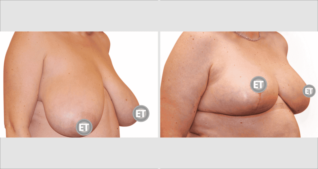 Vorher/Nachher Ergebnis: Brustverkleinerung
