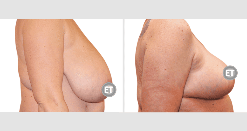 Vorher/Nachher Ergebnis: Brustverkleinerung