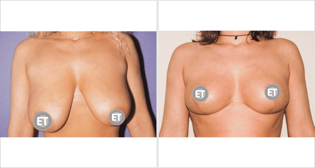 Vorher/Nachher Ergebnis: Brustverkleinerung