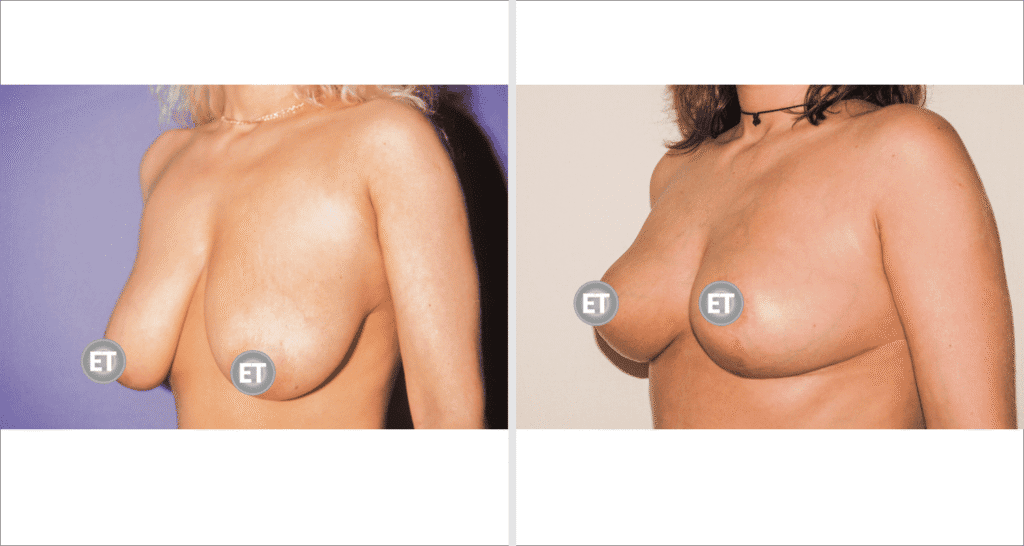 Vorher/Nachher Ergebnis: Brustverkleinerung