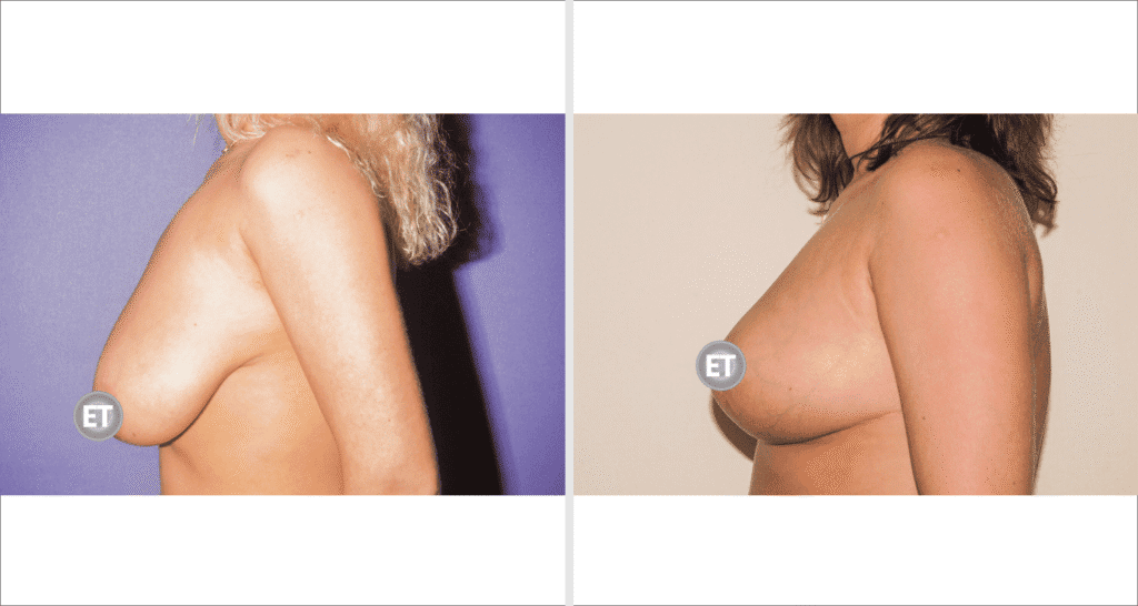 Vorher/Nachher Ergebnis: Brustverkleinerung