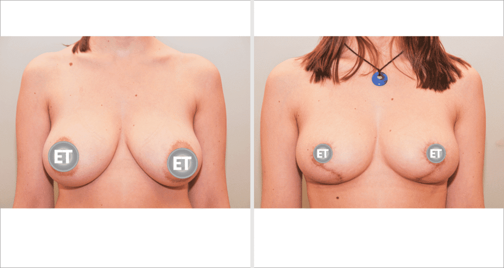 Vorher/Nachher Ergebnis: Brustverkleinerung