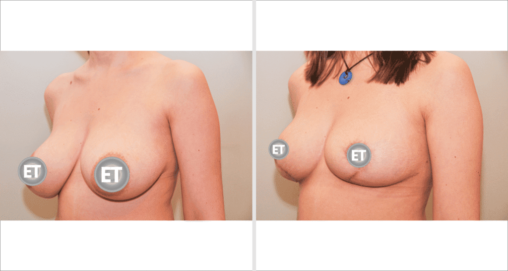 Vorher/Nachher Ergebnis: Brustverkleinerung
