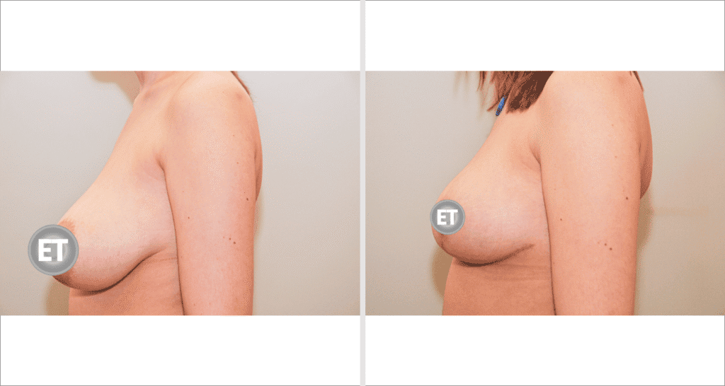 Vorher/Nachher Ergebnis: Brustverkleinerung