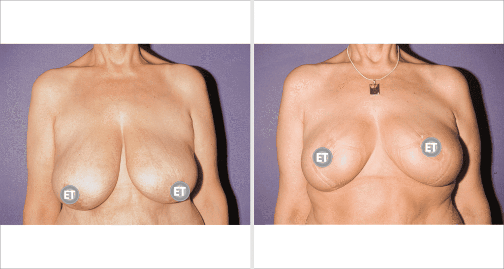 Vorher/Nachher Ergebnis: Brustverkleinerung