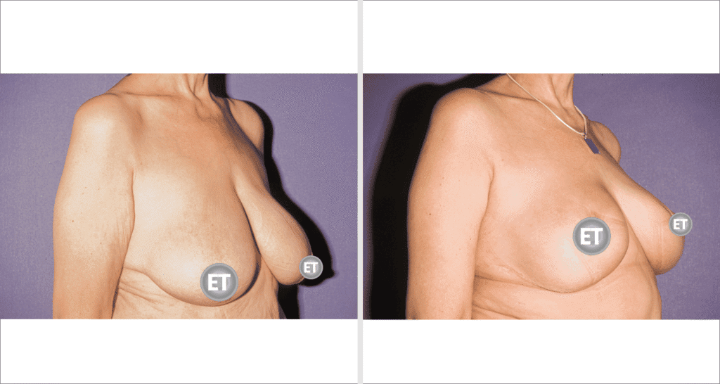 Vorher/Nachher Ergebnis: Brustverkleinerung