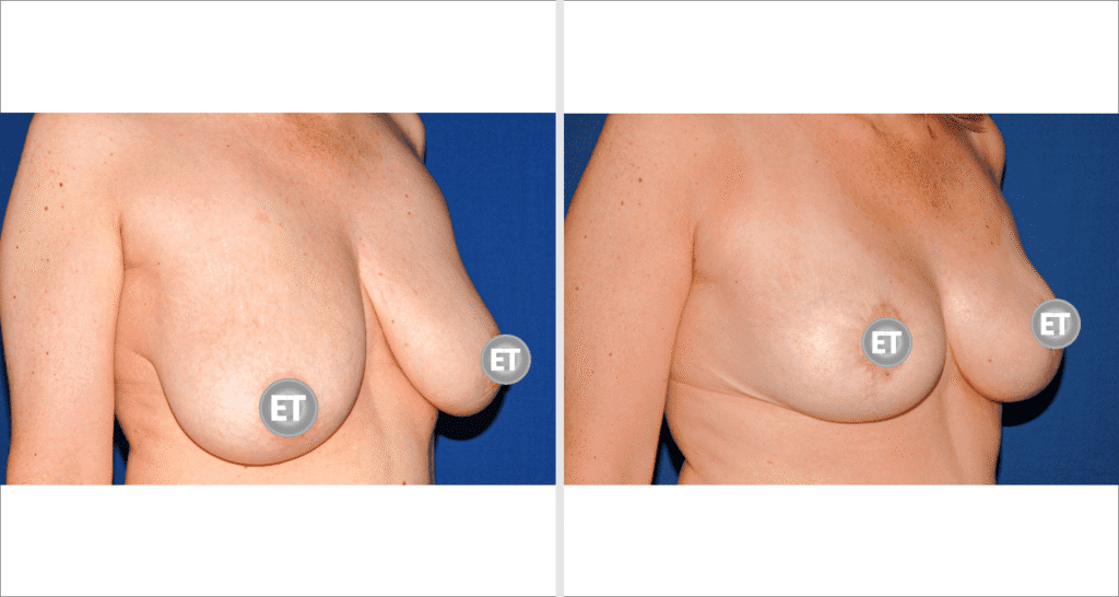 Vorher/Nachher Ergebnis: Brustverkleinerung
