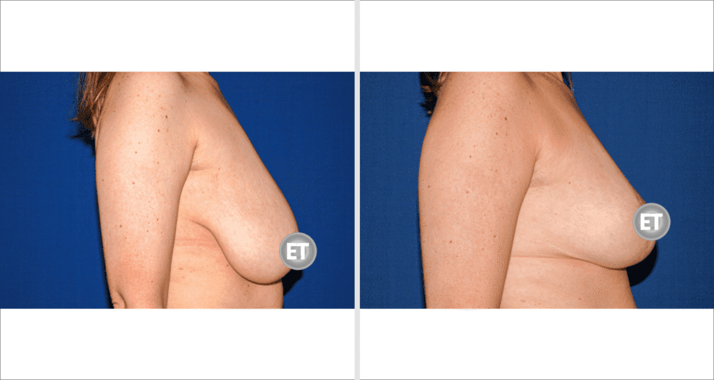 Vorher/Nachher Ergebnis: Brustverkleinerung