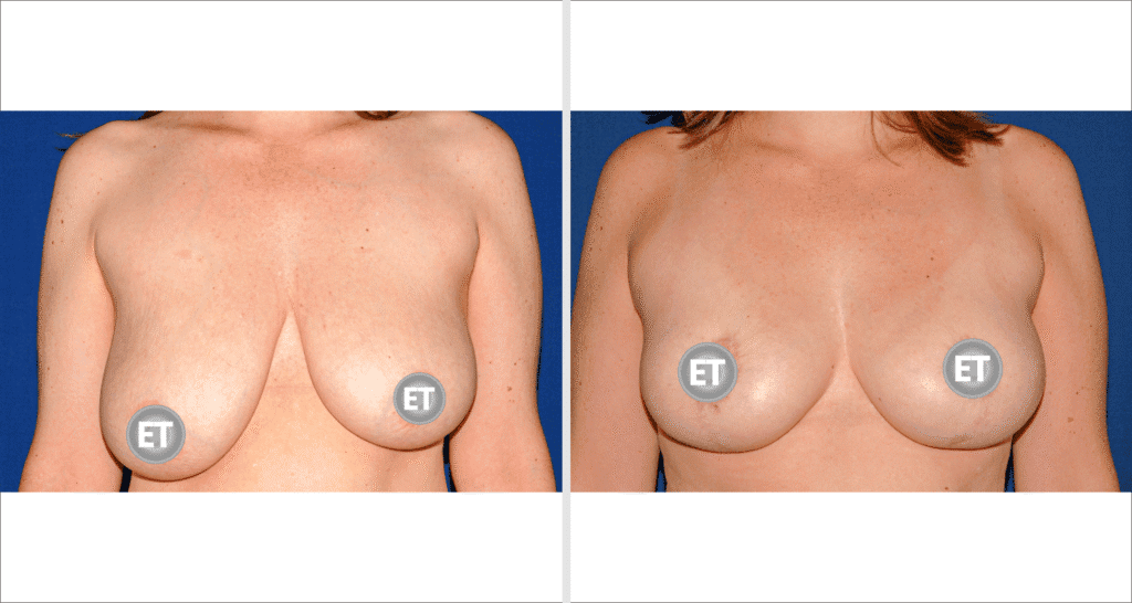 Vorher/Nachher Ergebnis: Brustverkleinerung