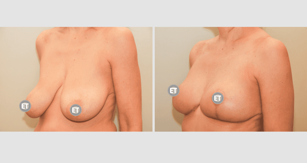 Vorher/Nachher Ergebnis: Brustverkleinerung