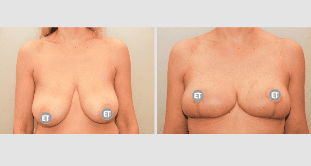 Vorher/Nachher Ergebnis: Brustverkleinerung