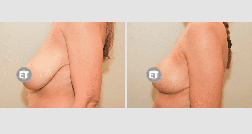Vorher/Nachher Ergebnis: Brustverkleinerung