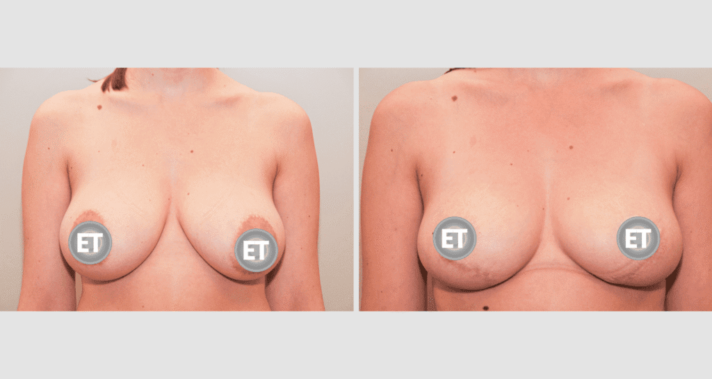 Vorher/Nachher Ergebnis: Brustverkleinerung