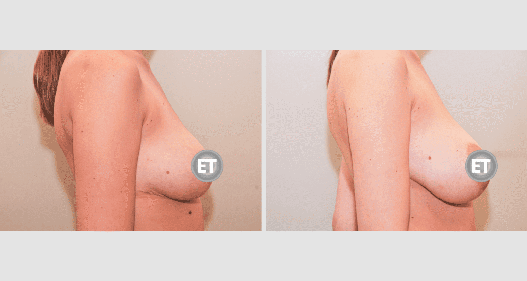 Vorher/Nachher Ergebnis: Brustverkleinerung