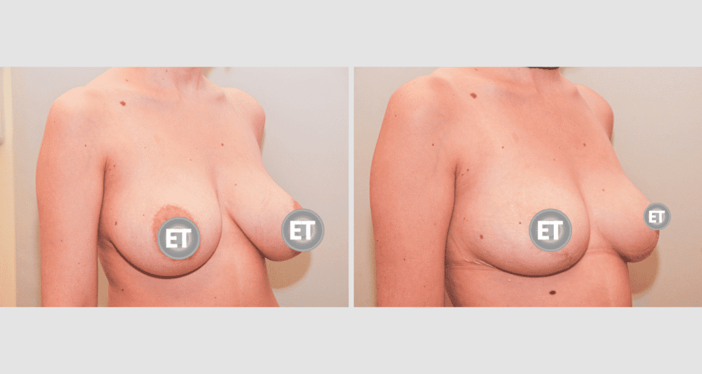 Vorher/Nachher Ergebnis: Brustverkleinerung