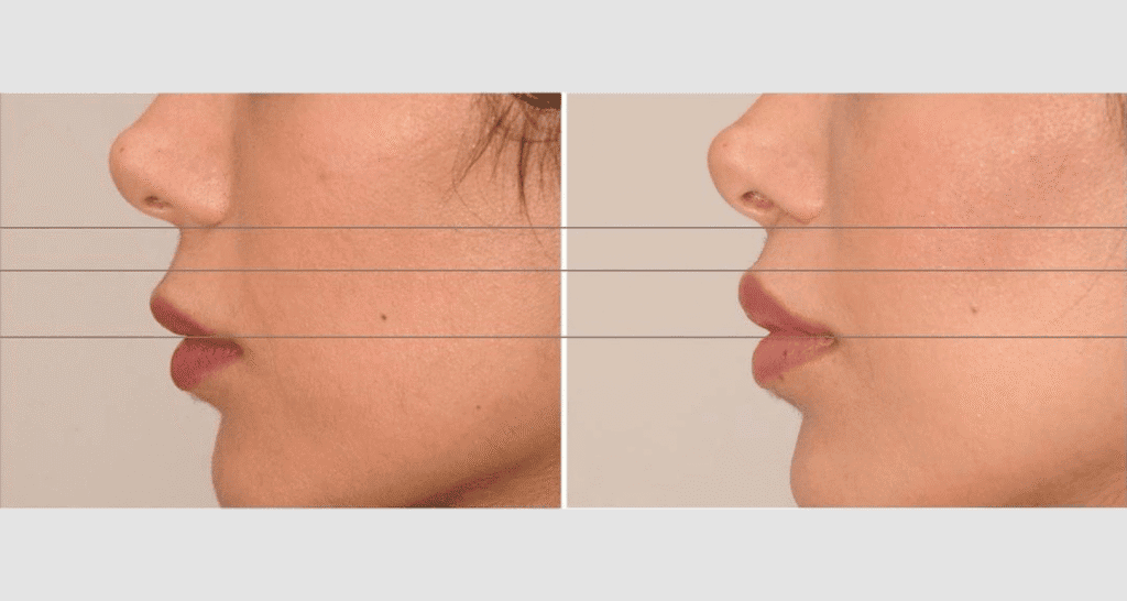 Vorher/Nachher Ergebnis: Bullhorn Lift