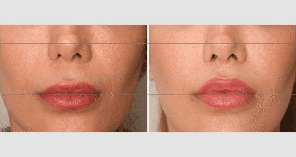 Vorher/Nachher Ergebnis: Bullhorn Lift