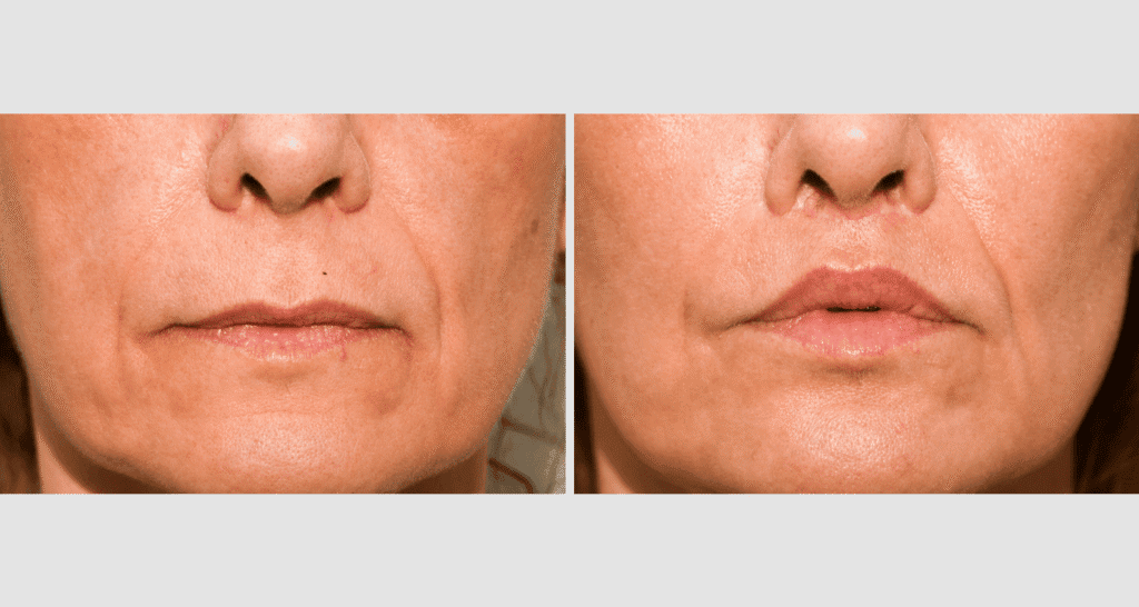 Vorher/Nachher Ergebnis: Bullhorn Lift