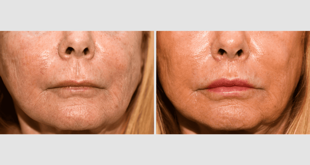 Vorher/Nachher Ergebnis: Bullhorn Lift