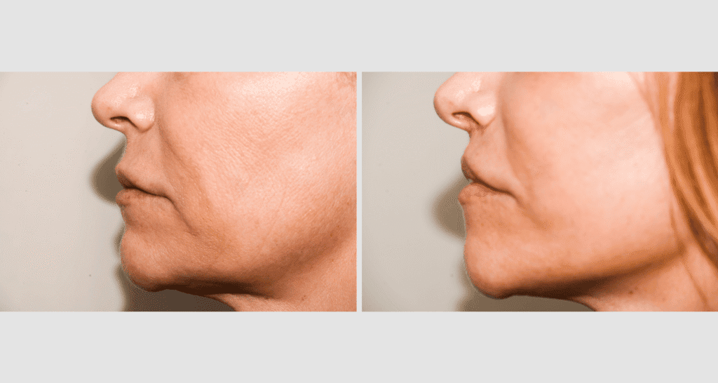 Vorher-Nachher Vergleich, Anti-Aging Behandlung.