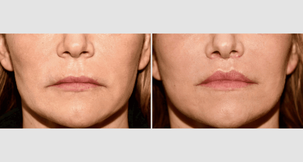 Vorher/Nachher Ergebnis: Bullhorn Lift