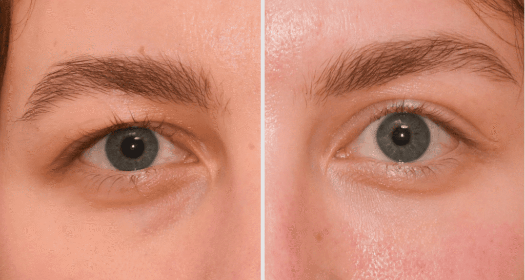 Vorher/Nachher Ergebnis: Eigenfett Augenringe